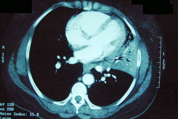 Lingular-pneumonia-CT1.jpg