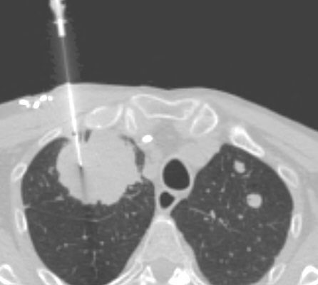 CT_Guided_Lung_Biopsy1.jpg