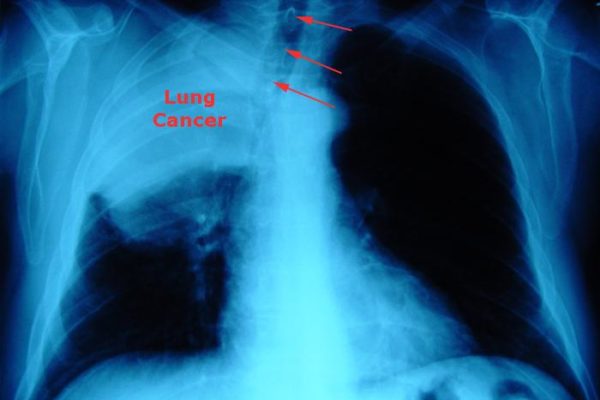 chest_x-ray_lung-cancer.jpg