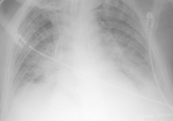 clearing_pulmonary_edema_2-days-earlier-opt.jpg