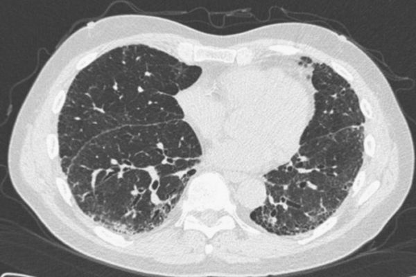 interstitial-lung-disease-fig3_large.jpg