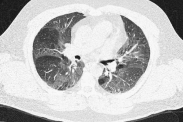interstitial-lung-disease-fig4_large1.jpg