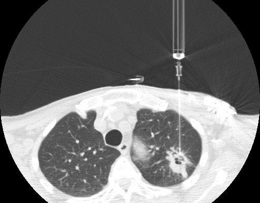 ct-guided-percutaneous-lung-biopsy.jpg