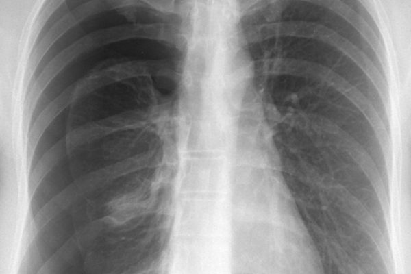pneumothorax.sized_.jpg