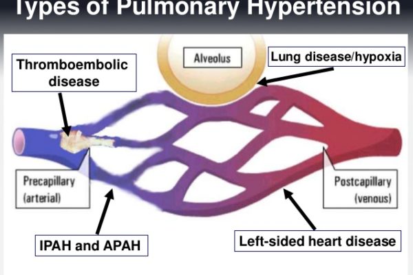 pulmonary-arterial-hypertension-in-rural-communities-early-diagnosis-and-intervention-to-improve-outcomes-8-6381.jpg