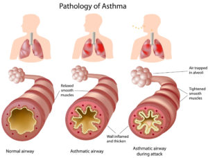 anatomy-of-asthma-300x228.jpg