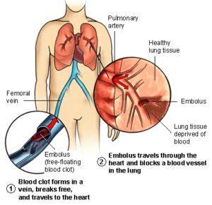 pulmonary_embolism-300x290.jpg