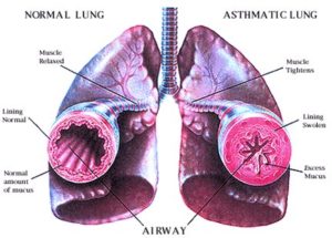 Asthma2-300x215.jpg