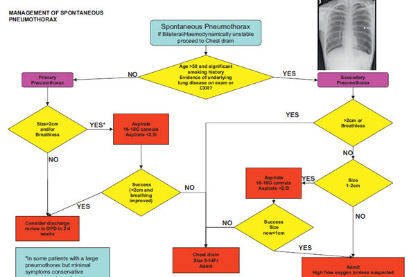 pneumothorax-guidance.jpg