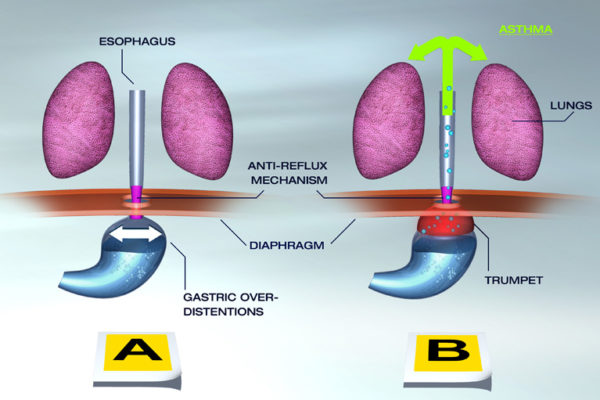 reflux_asthma_diagram_02_ENGL.jpg