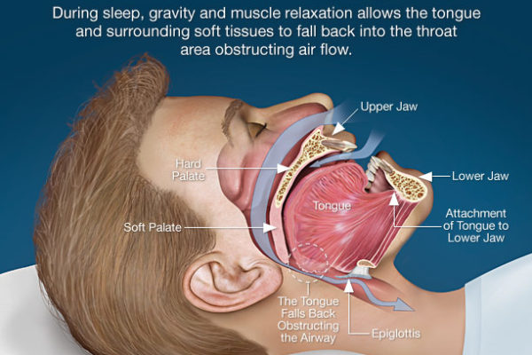 obstructive-sleep-apnea.jpg