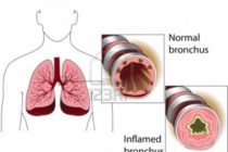 13357733-the-bronchial-tubes-of-healthy-person-and-a-person-suffering-from-bronchial-asthma-medical-poster-300x298.jpg
