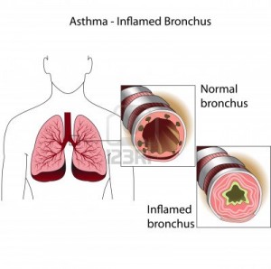 13357733-the-bronchial-tubes-of-healthy-person-and-a-person-suffering-from-bronchial-asthma-medical-poster-300x298.jpg