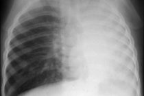 Atelectasis-L-lung-asthma.jpg