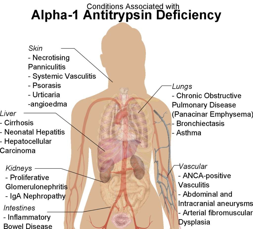 Conditions_associated_with_Alpha-1_Antitrypsin_Deficiency.png