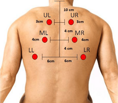 Six-posterior-chest-location-for-auscultation-Figure-1-Six-posterior-chest-location-for